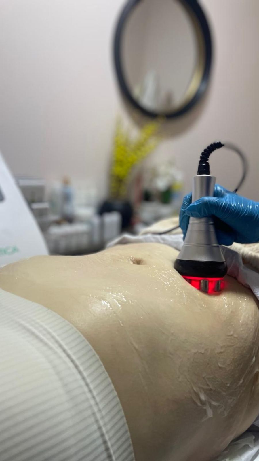 Modelado corporal con lipocavitación y radiofrecuencia en Estética SanVi